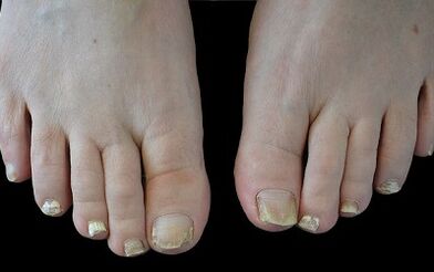 Comment se débarrasser du champignon sur vos doigts