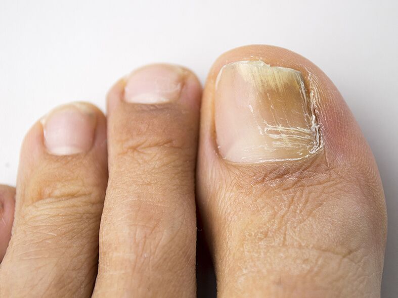 L'étape initiale du champignon