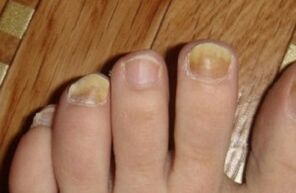 jaunissement de l'ongle dû à un champignon